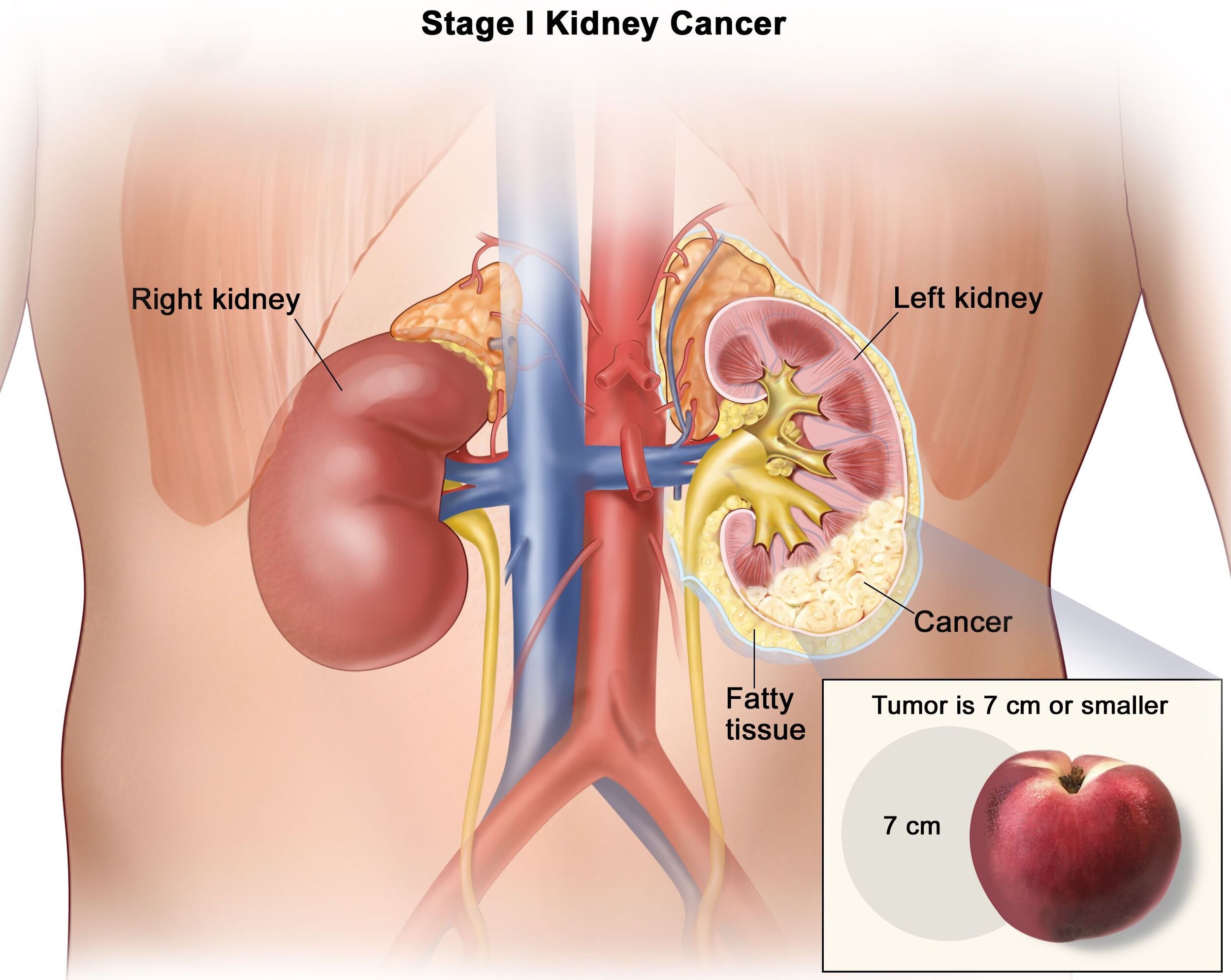 Kidney Cancer — Adelaide Urology Care